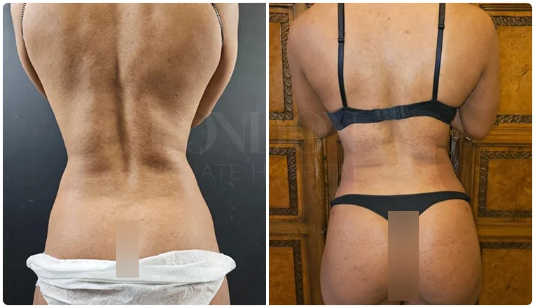 back lipo before and after patient-1