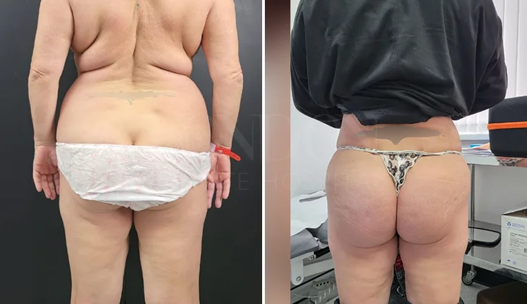 back lipo before and after patient