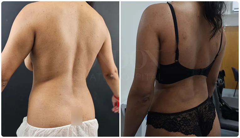 back vaser liposuction before and after patient-1-v1