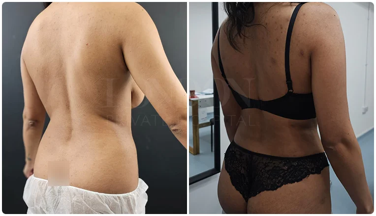 back vaser liposuction before and after patient-1-v2