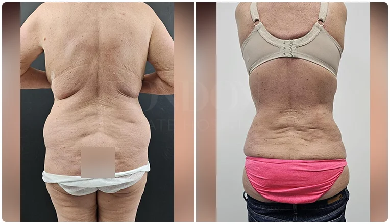 back vaser liposuction before and after patient-2