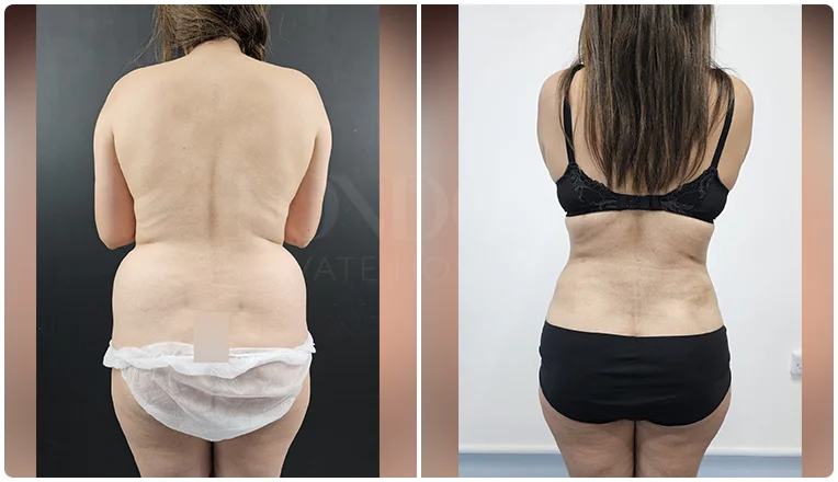 back vaser liposuction before and after patient-3