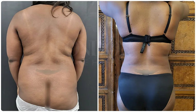 back vaser liposuction before and after patient-4