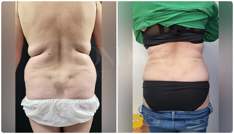 back vaser liposuction before and after patient-5