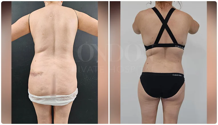 back vaser liposuction before and after patient-6