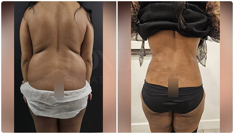 back vaser liposuction before and after patient-7