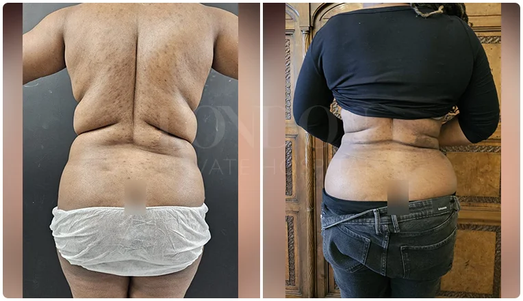 back vaser liposuction before and after patient-8