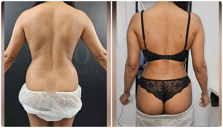 back vaser liposuction before and after patient