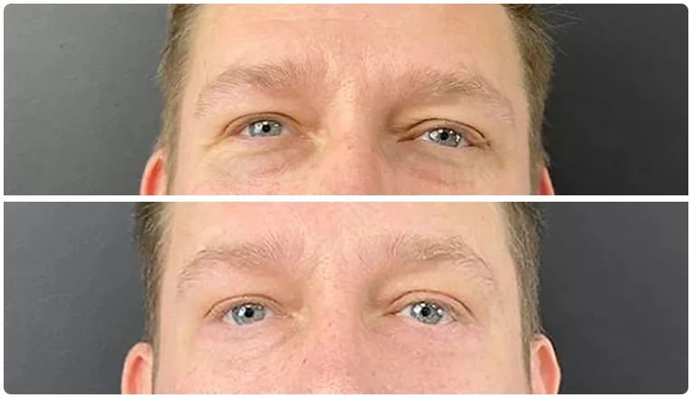 blepharoplasty before and after result patient - 1