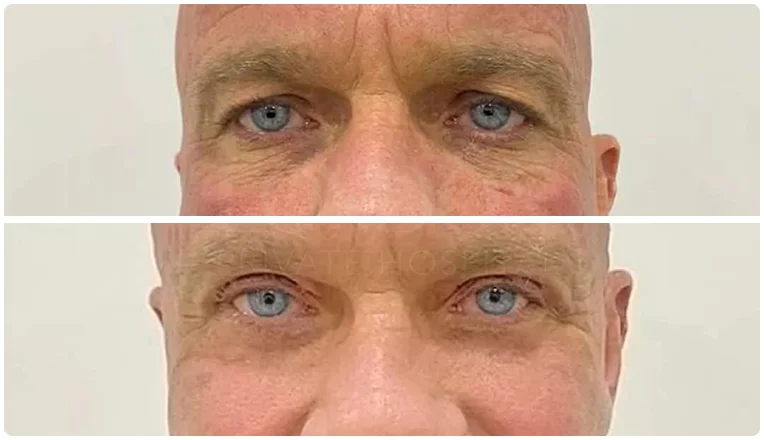 blepharoplasty before and after result patient -2