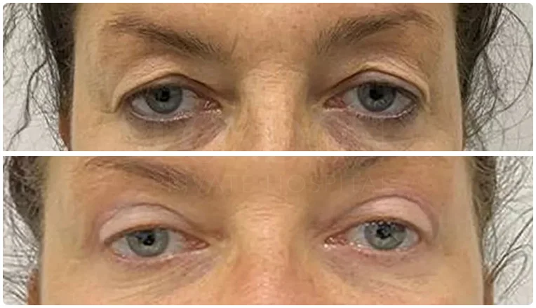 blepharoplasty before and after result patient - 3