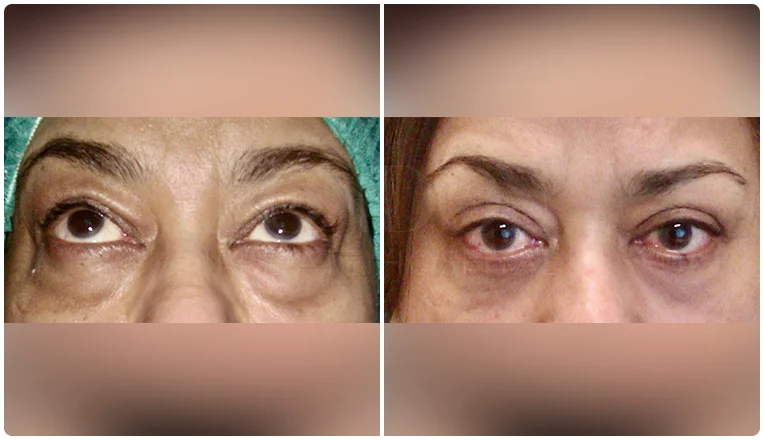 blepharoplasty before and after result patient - 4