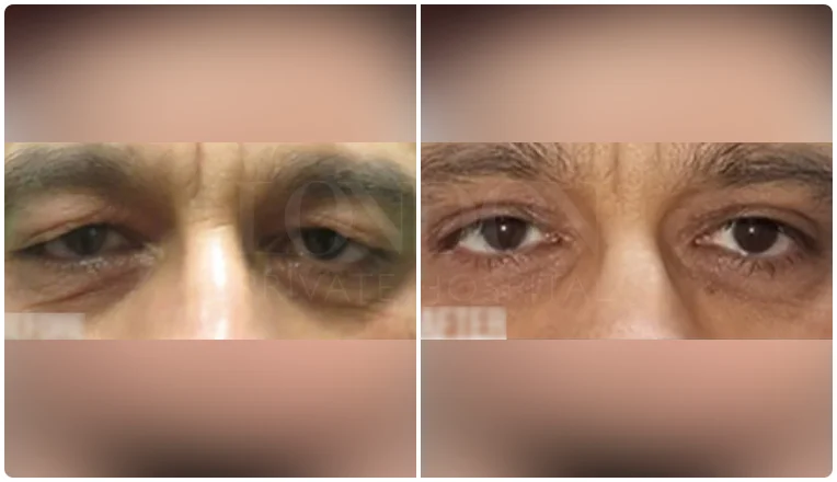 blepharoplasty before and after result patient - 5