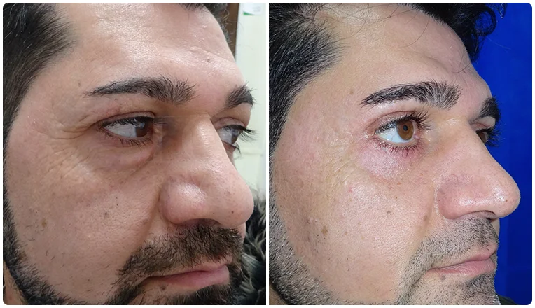 blepharoplasty before and after result patient - 6-v1