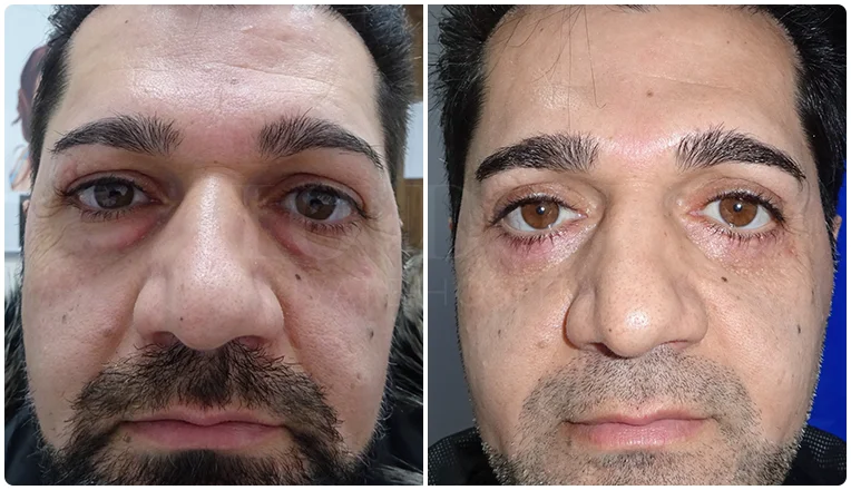 blepharoplasty before and after result patient - 6