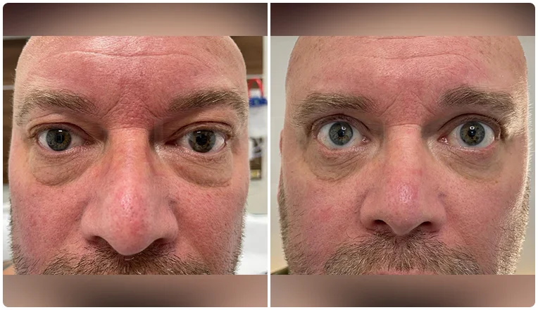 blepharoplasty before and after result patient - 7