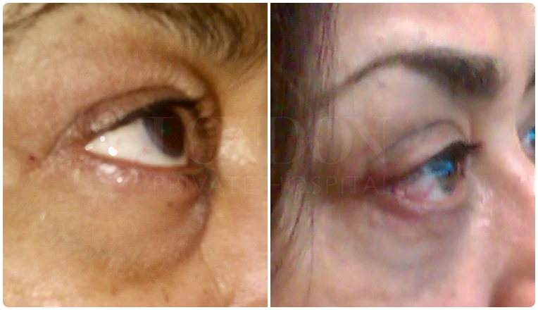 blepharoplasty before and after result patient - 8