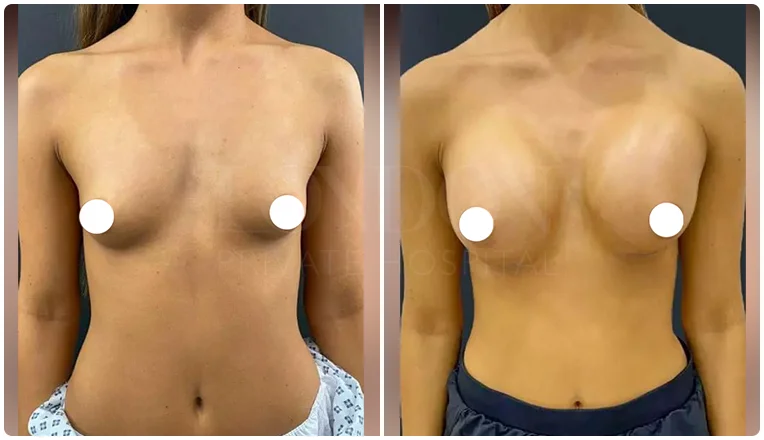 boob job before and after patient-1