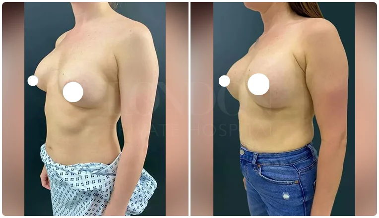 boob job before and after patient-2-v1