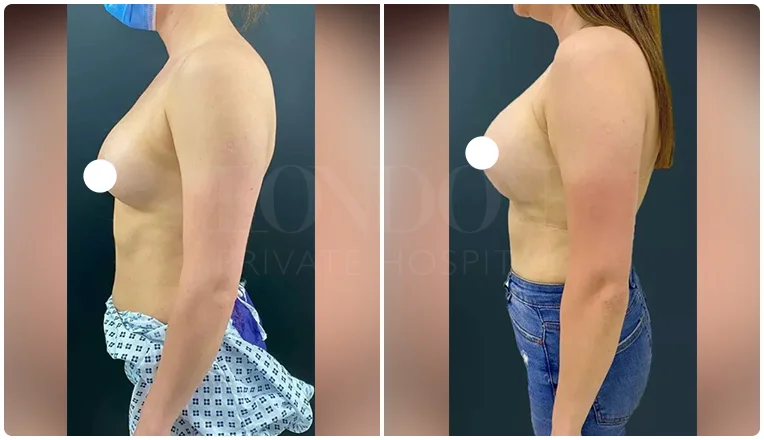 boob job before and after patient-2-v2