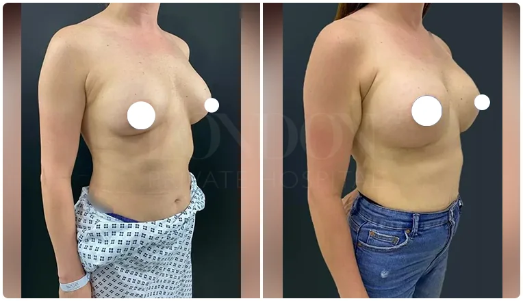 boob job before and after patient-2-v3