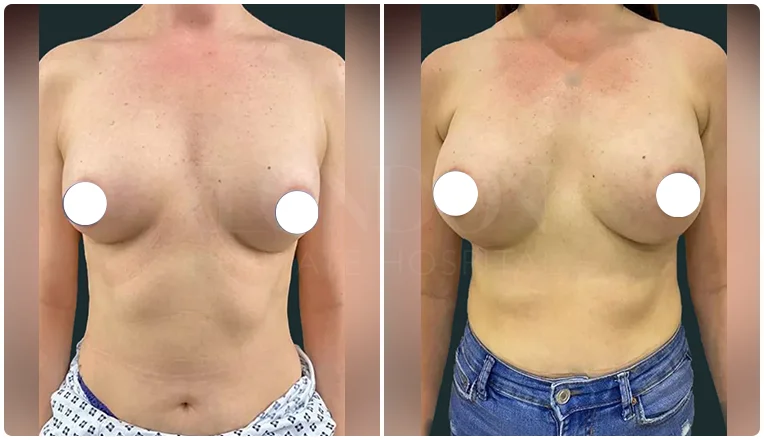 boob job before and after patient-2