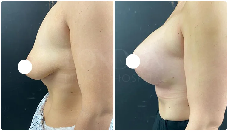 boob job before and after patient-3-v1