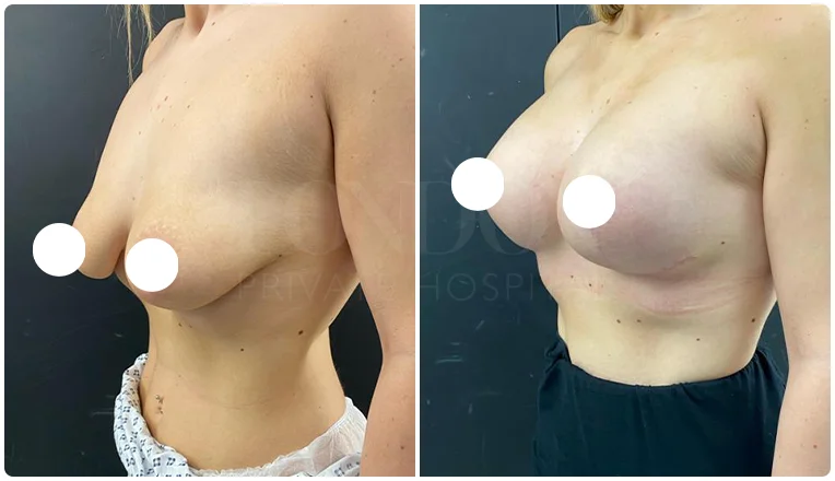 boob job before and after patient-3-v2