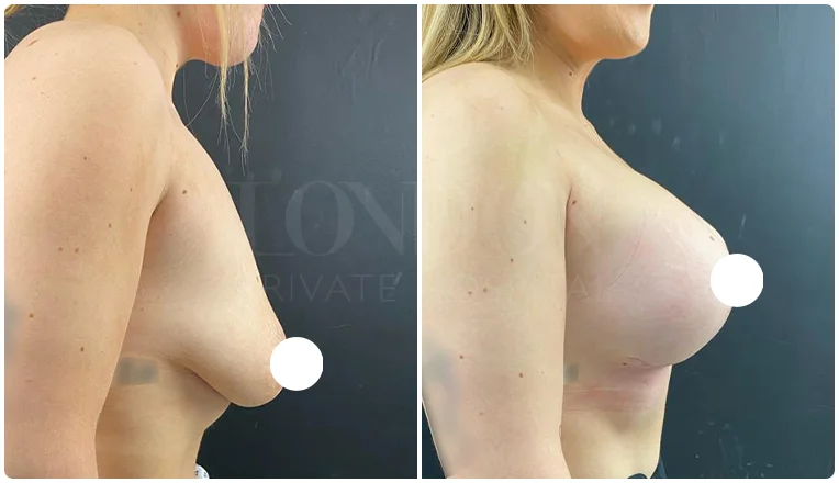 boob job before and after patient-3-v3