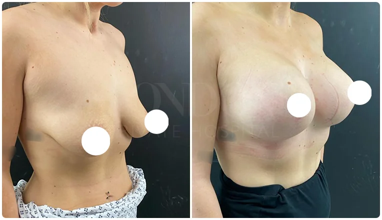 boob job before and after patient-3-v4