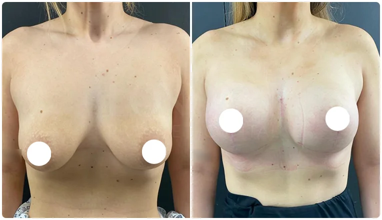 boob job before and after patient-3