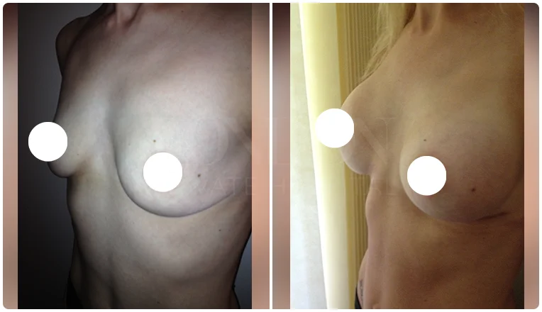 boob job before and after patient-4-v1