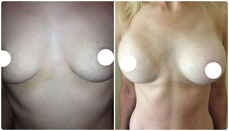 boob job before and after patient-4