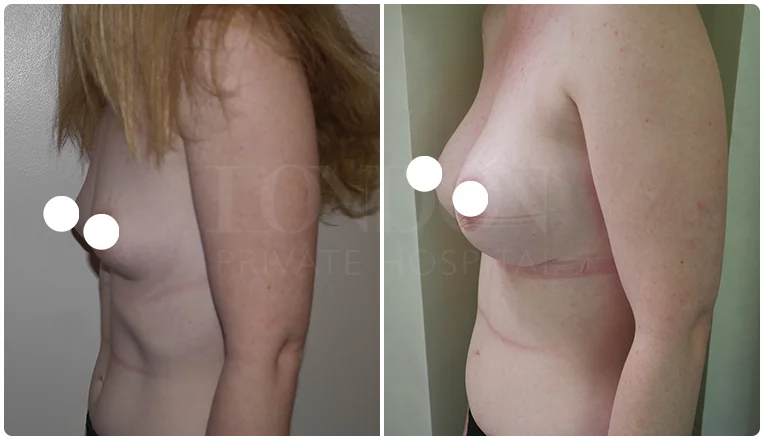 boob job before and after patient-6-v1