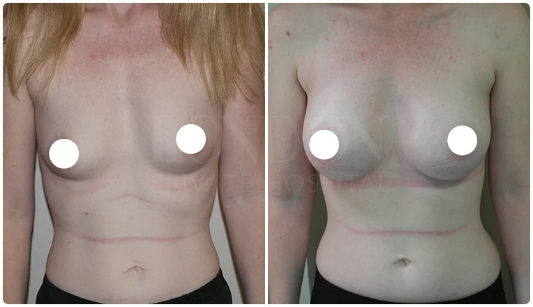 boob job before and after patient-6