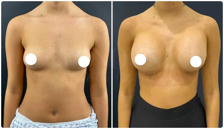 boob job before and after patient