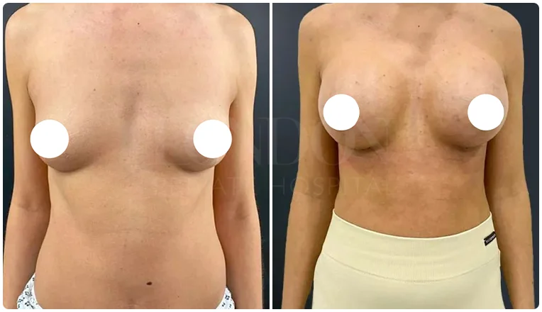 breast enlargement before and after patient-15