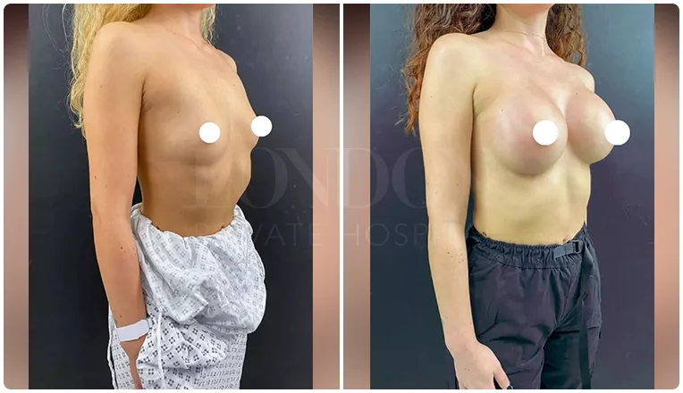 breast enlargement before and after patient-16