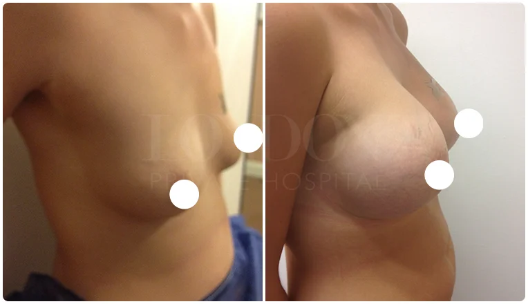 breast enlargement before and after patient result-1-v1