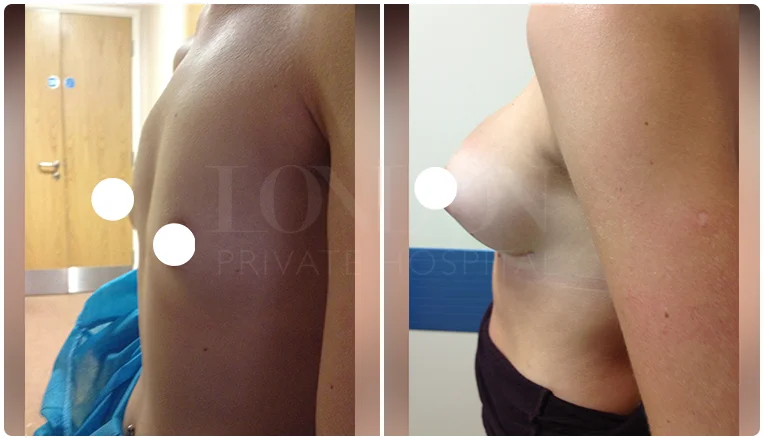 breast enlargement before and after patient result-2-v1