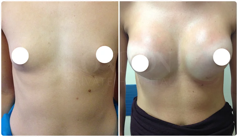 breast enlargement before and after patient result-2