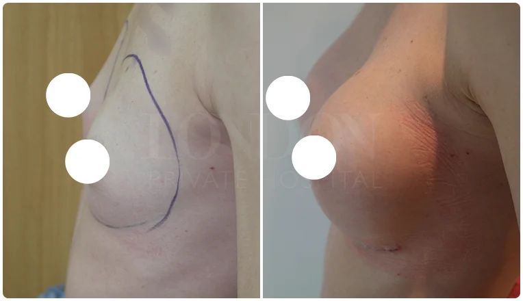 breast enlargement before and after patient result-3-v1