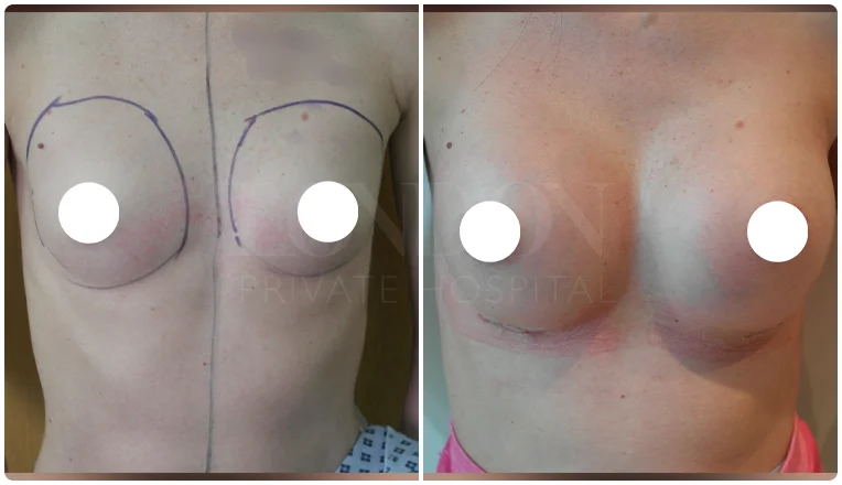 breast enlargement before and after patient result-3