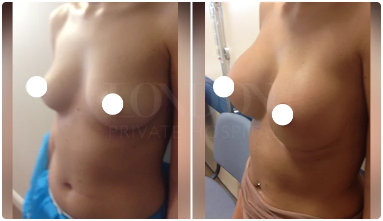 breast enlargement before and after patient result-v1