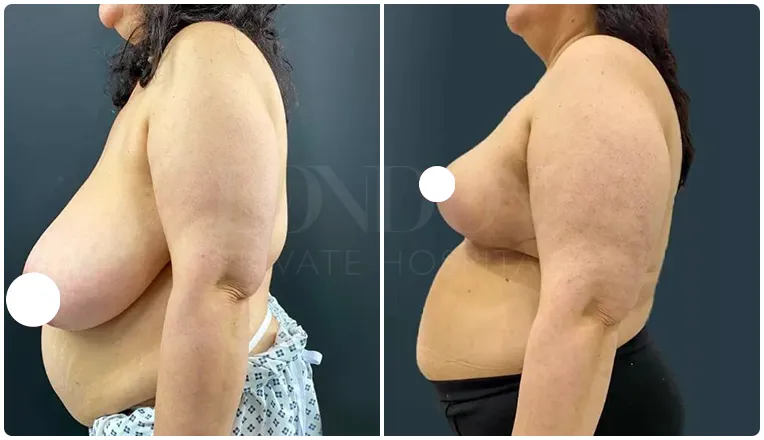 breast reduction surgery before and after patient - 6-v1