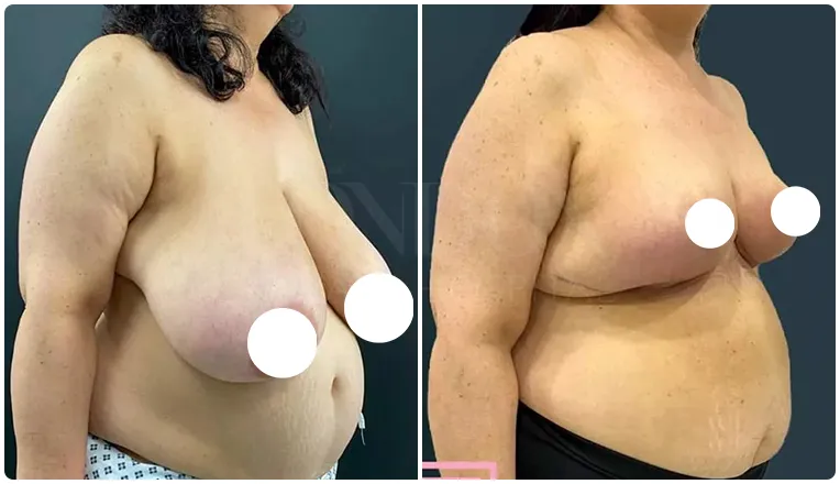 breast reduction surgery before and after patient - 6-v2