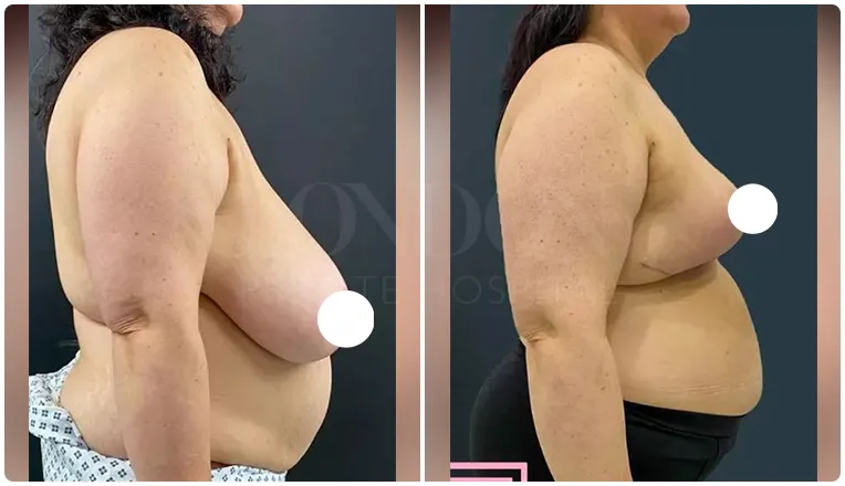 breast reduction surgery before and after patient - 6-v3