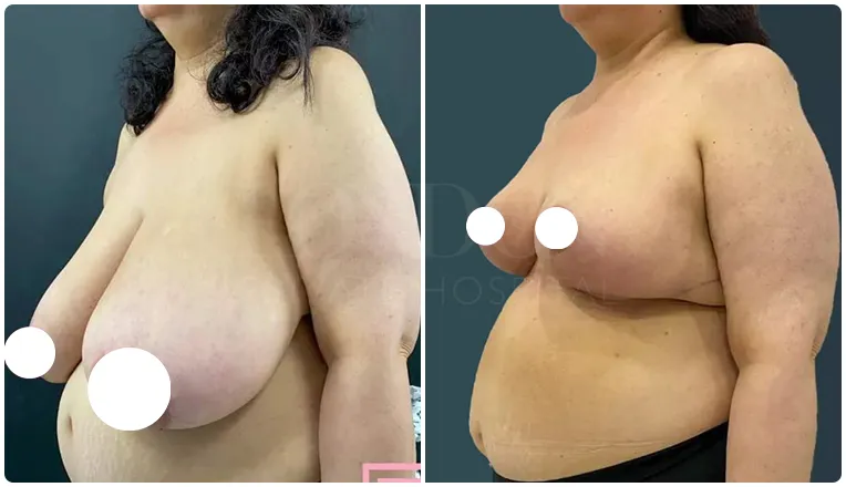 breast reduction surgery before and after patient - 6