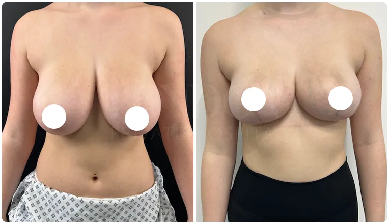 breast reduction surgery before and after patient - 7