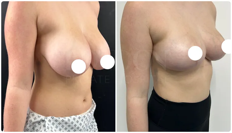 breast reduction surgery before and after patient - 7-v1